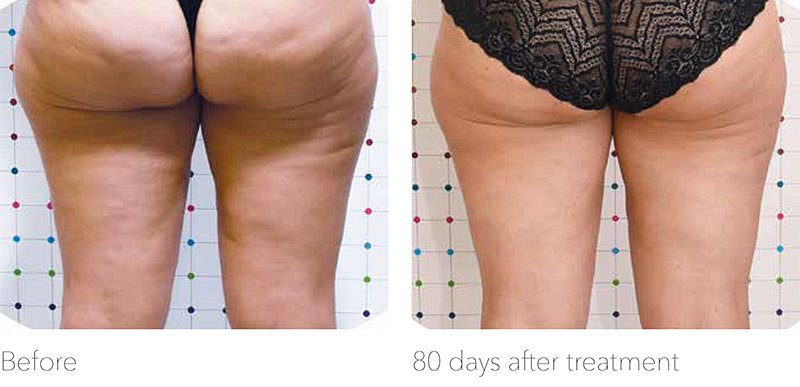 Onda - przed i po redukcji cellulitu