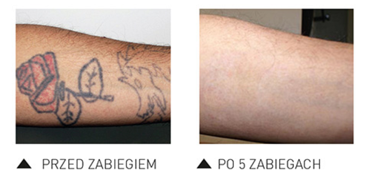 efekty po usuwaniu tatuazu